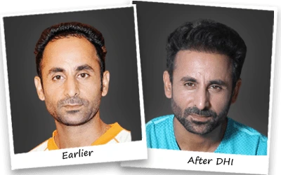 Prabhjot singh hair transplant