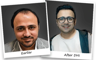 Shaad Rahman hair transplant