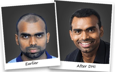 Parattu Raveendran Sreejesh hair transplant