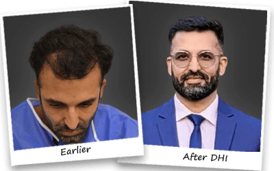 shail hair transplant