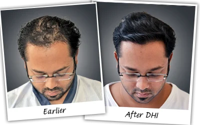 Avhishek hair transplant