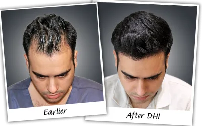 Best Hair Transplant