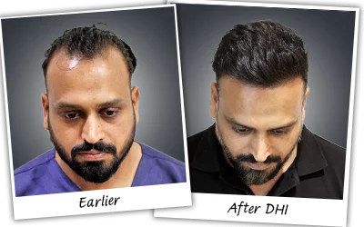 GAURAV-GARG hair transplant