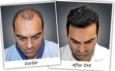 Kunal hair transplant