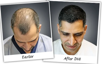 Best Hair Transplant lucknow