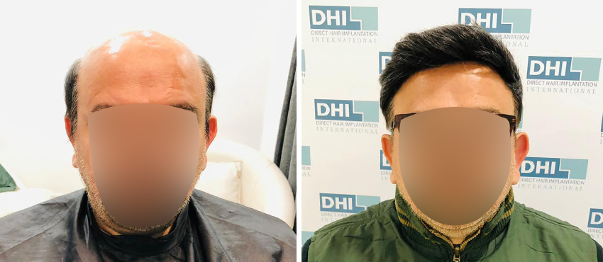  dhf results