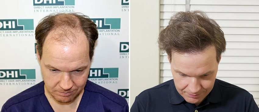 dhi gives natural hairline