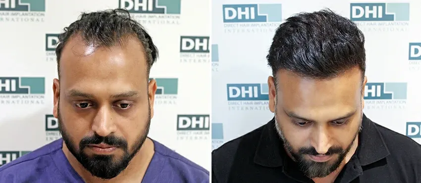 DHI before & after hair transplant results