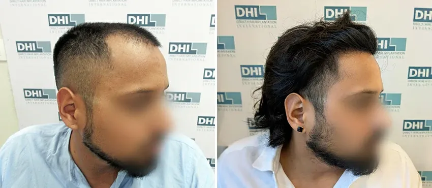 DHI before & after hair transplant results