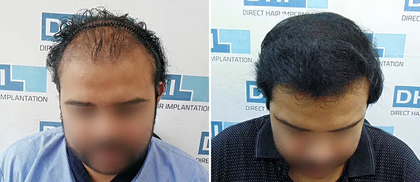 DHI before & after hair transplant results