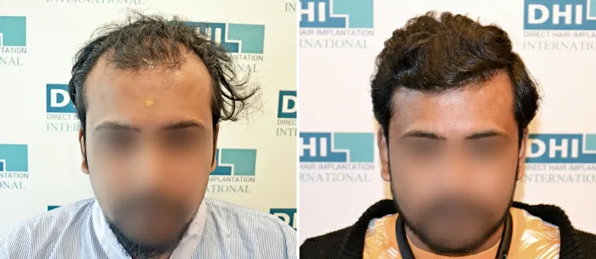 DHI before & after hair transplant results