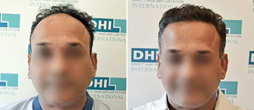DHI before & after hair transplant results
