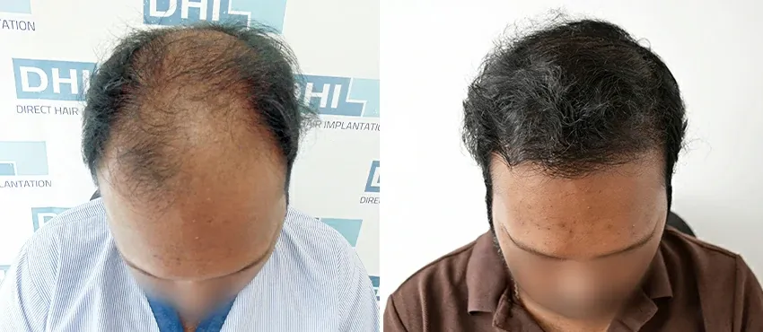 DHI before & after hair transplant results