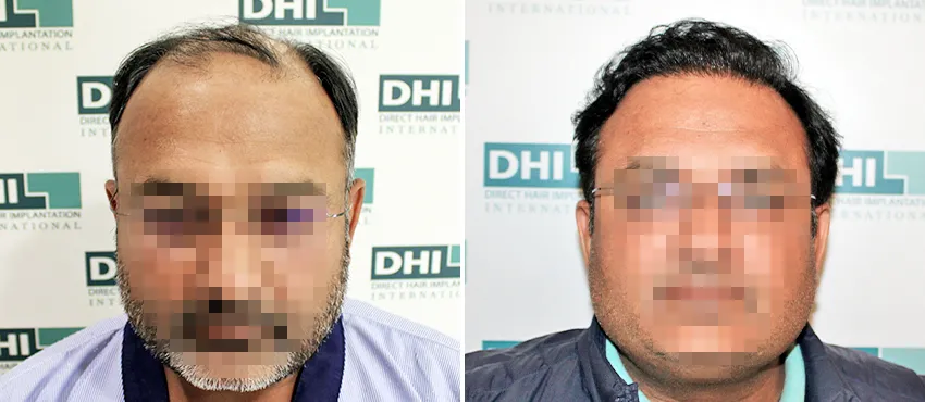 DHI before & after hair transplant results