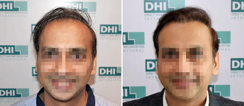 DHI before & after hair transplant results