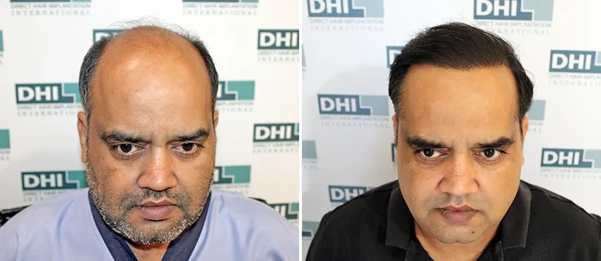 DHI before & after hair transplant results