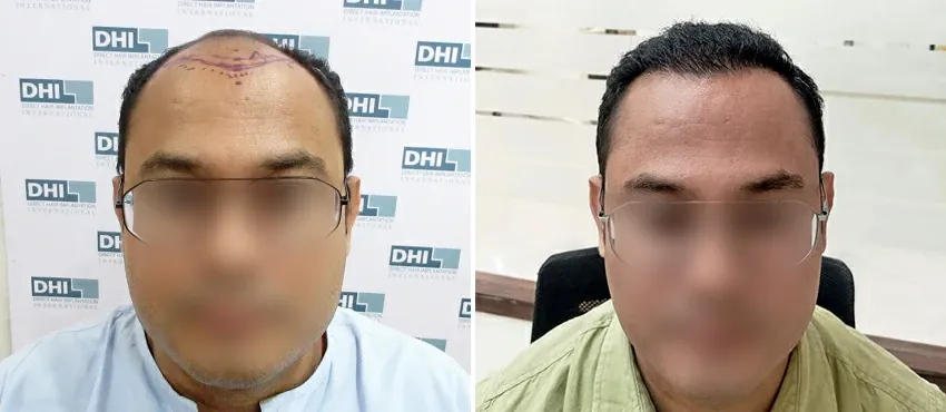 DHI before & after hair transplant results