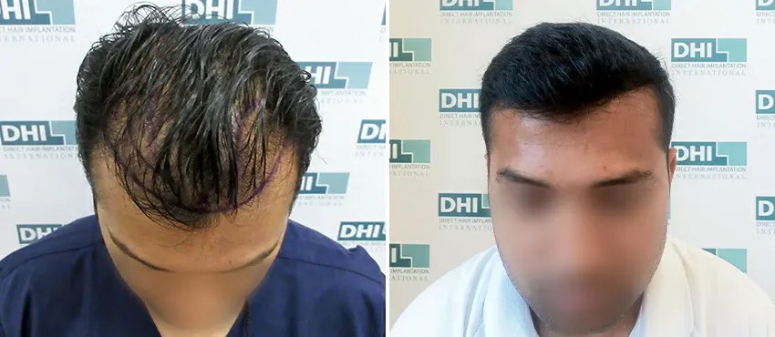 DHI before & after hair transplant results