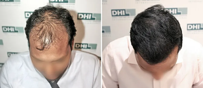 DHI before & after hair transplant results