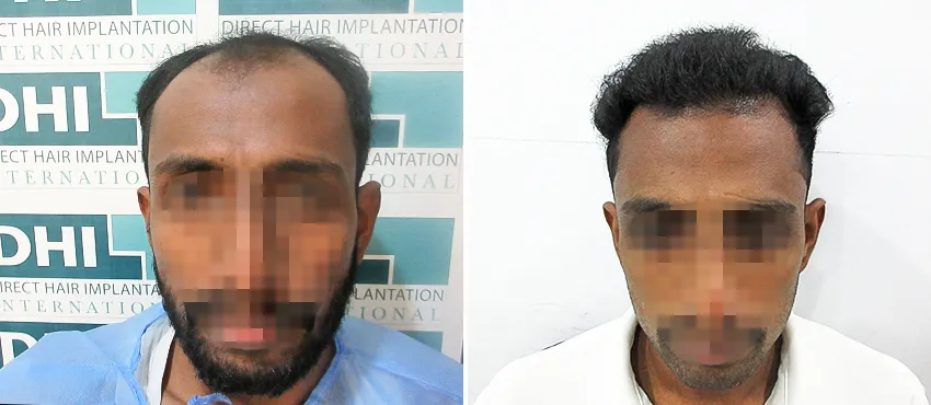 DHI before & after hair transplant results