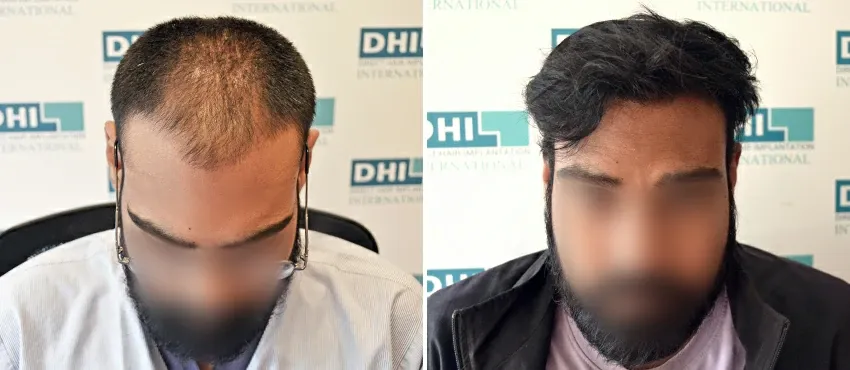 DHI before & after hair transplant results
