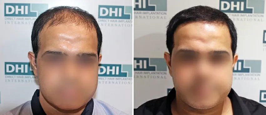 DHI before & after hair transplant results