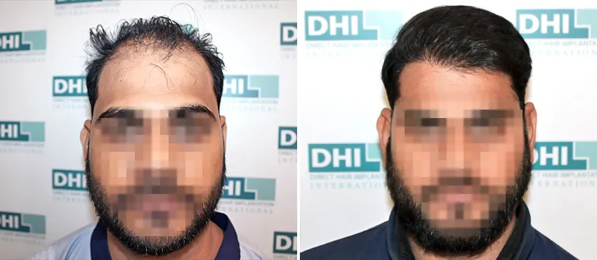 DHI before & after hair transplant results