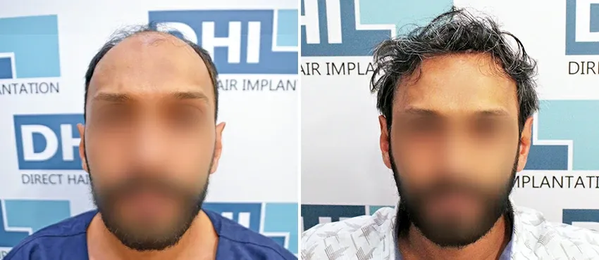 DHI before & after hair transplant results