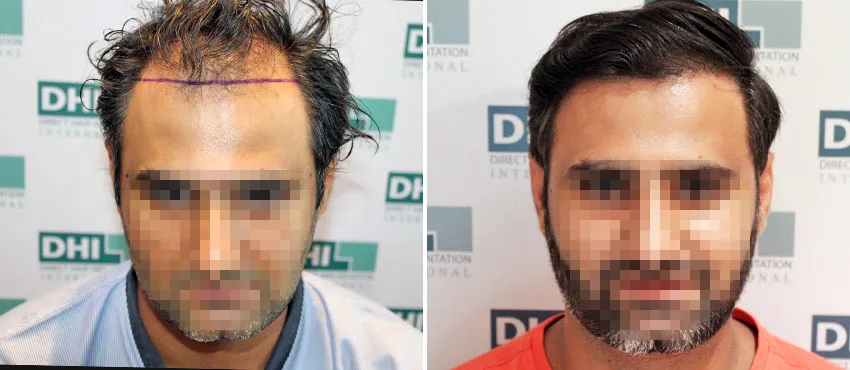 DHI before & after hair transplant results