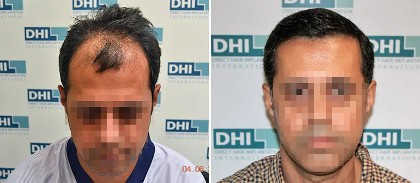 DHI before & after hair transplant results