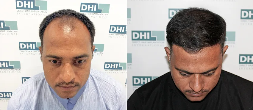 DHI before & after hair transplant results