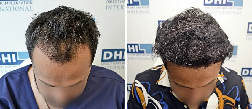 DHI before & after hair transplant results