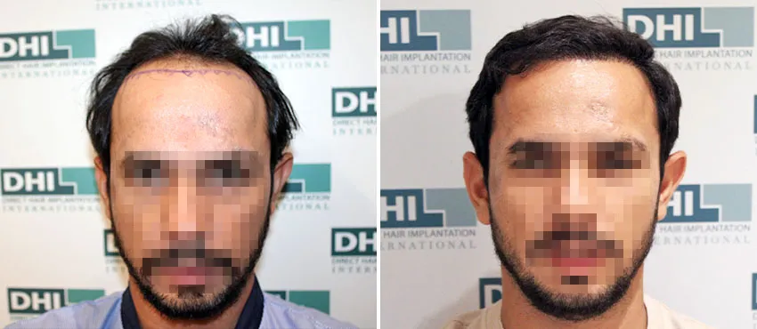 DHI before & after hair transplant results