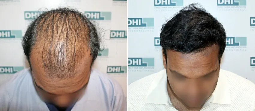 DHI before & after hair transplant results