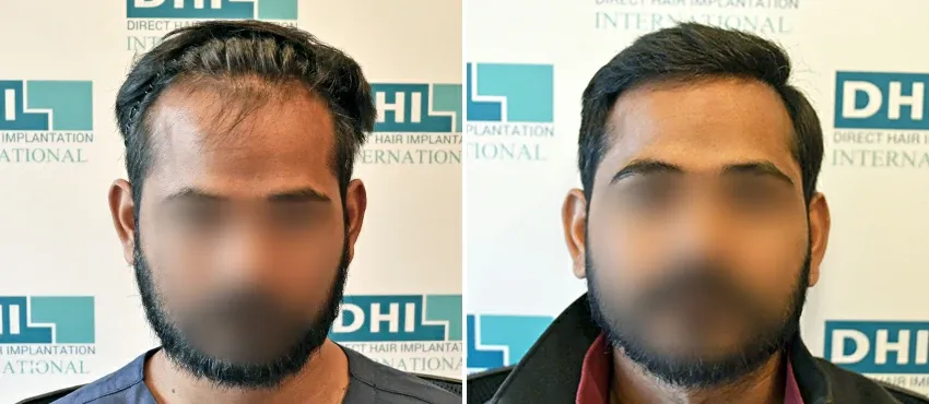 DHI before & after hair transplant results