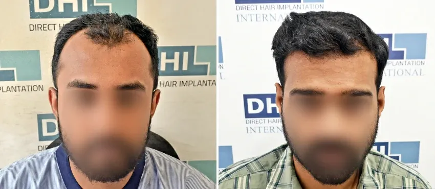 DHI before & after hair transplant results