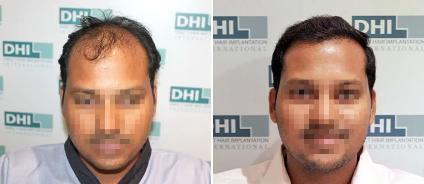 DHI before & after hair transplant results