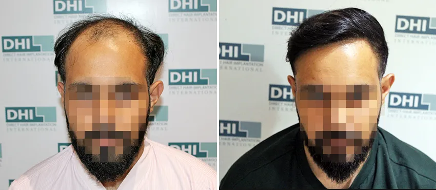 DHI before & after hair transplant results