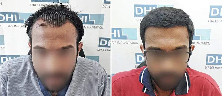 DHI before & after hair transplant results