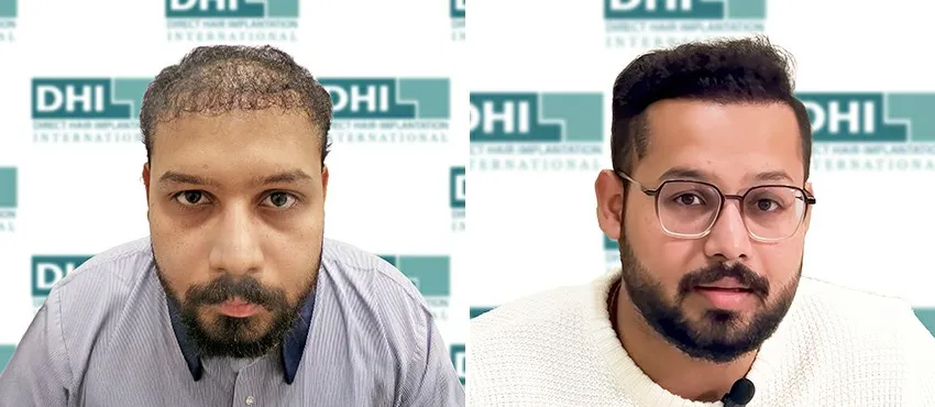 DHI before & after hair transplant results