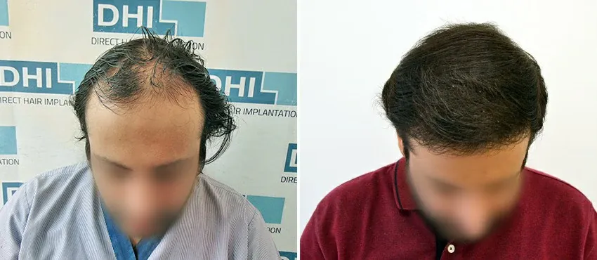 DHI before & after hair transplant results