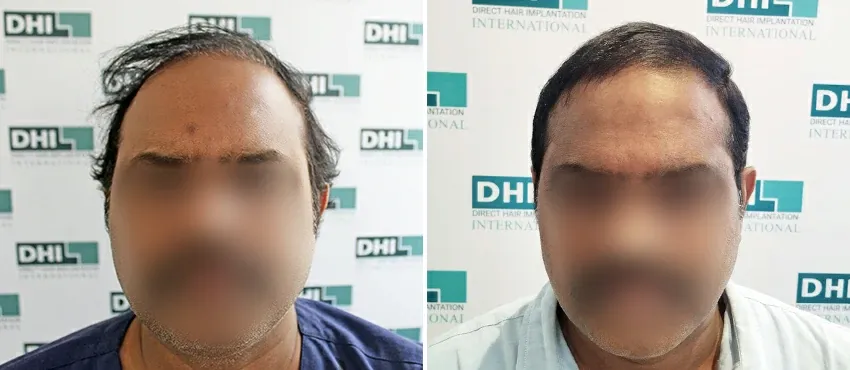 DHI before & after hair transplant results