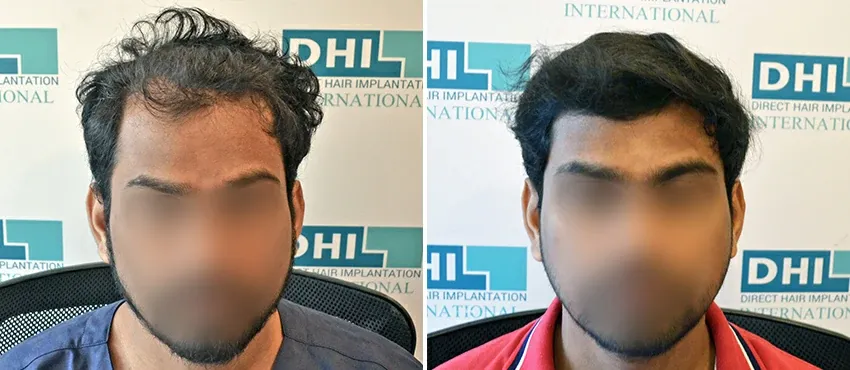 DHI before & after hair transplant results