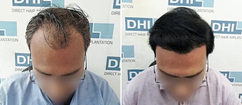 DHI before & after hair transplant results