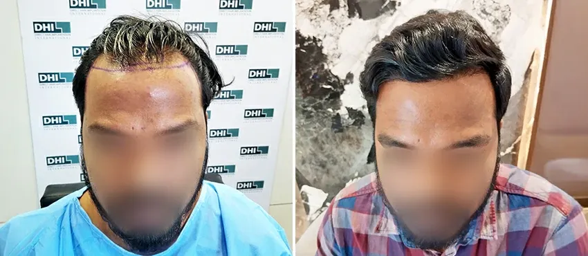 DHI before & after hair transplant results