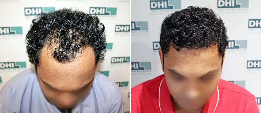DHI before & after hair transplant results