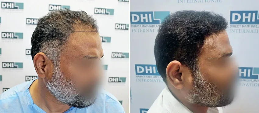 DHI before & after hair transplant results
