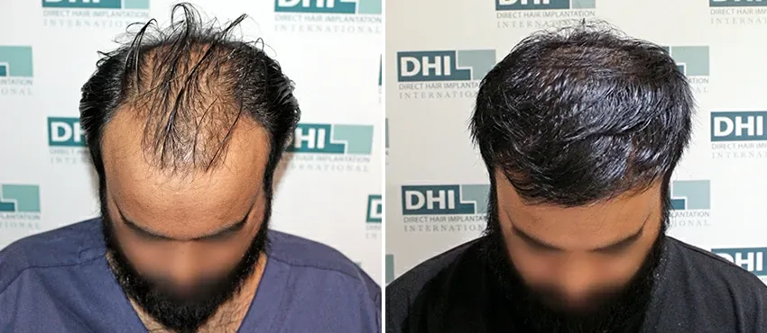 DHI before & after hair transplant results