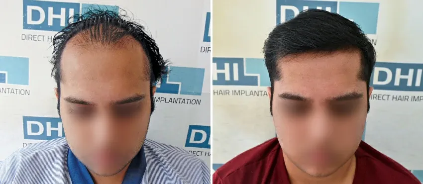DHI before & after hair transplant results