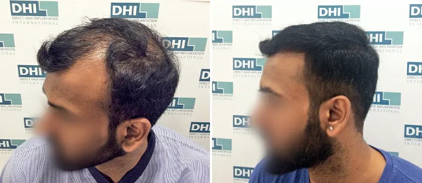 DHI before & after hair transplant results